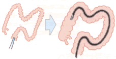 大腸内視鏡検査
