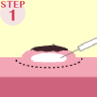 印をつけた患部の中に薬液を入れこぶを作る